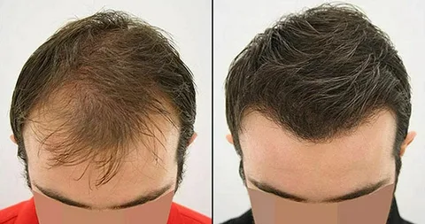 Hair Transplant in Islamabad